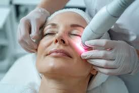 Trattamento con laser CO2 frazionato